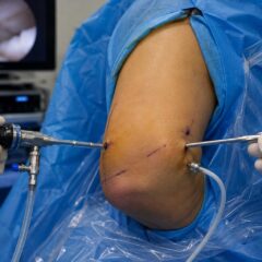 Αρθροσκόπηση αγκώνα (Elbow Arthroscopy)