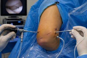 Arthroscopic surgery on an elbow with surgical instruments inserted through small incisions
