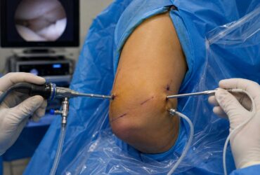 Elbow-Arthroscopy Arthroscopic surgery on an elbow with surgical instruments inserted through small incisions