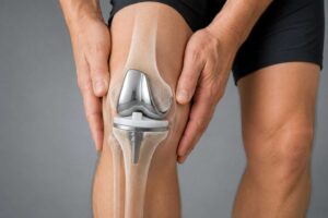 Knee joint with a knee replacement implant and hands supporting the leg