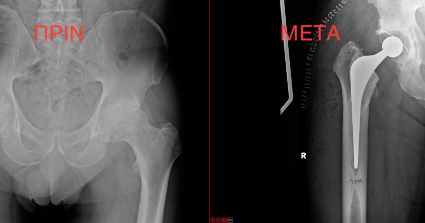 End-stage hip osteoarthritis